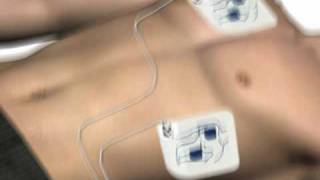 How to use an AED automated external defibrillator [upl. by Ihtak96]