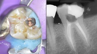 LIVE Molar Root Canal w Hyperemic Pulp  Distal Caries Molar Access FULL LENGTH [upl. by Butterworth495]