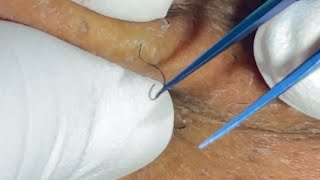 Beard Plucking Ingrown Hair Removal Zoom in Satisfying ep26 [upl. by Erma281]