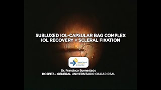 Subluxed IOLcapsular bag complex [upl. by Mars]