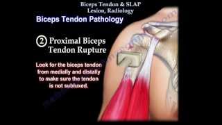 Biceps Tendon amp SLAP Lesion Radiology  Everything You Need To Know  Dr Nabil Ebraheim [upl. by Annawaj219]