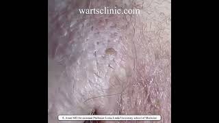 HPV warts Imiquimod and burning and podophyllin failed treatment  10 years of infection [upl. by Haelat]