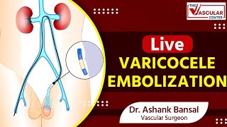 Live Varicocele Embolization Procedure with Dr Ashank Bansal [upl. by Adoree359]