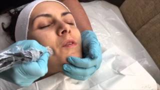 Collagen PIN Microneedling Skin Treatment by Qutis Witney [upl. by Odinevneib]