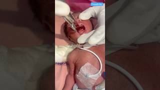 Et Tube Insertion medical nicu newbornbaby [upl. by Kristi564]