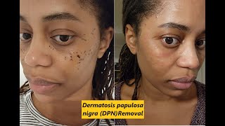 Dermatosis papulosa nigra DPN Removal [upl. by Bambi]