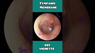 Tympanic membrane anatomy under 60 seconds  USMLE NCLEX  NEET PG [upl. by Glennie]