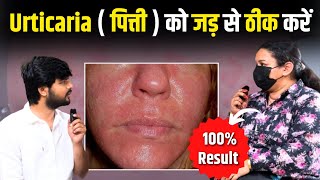 शितपित्त पित्ती का 100 गारंटी से इलाज  Urticaria Treatment  Hives on Skin  Dr Upasana Vohra [upl. by Oderfigis]