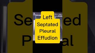 Septated Pleural Effusion  Lung Fluid  Dyspnoea ultrasound [upl. by Hammerskjold]