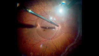 PostPnR Retinal Detachment with Proliferative Vitreoretinopathy Macula Spared Vitrectomy [upl. by Acinoj]