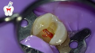 Live Premolar Root Canal Procedure [upl. by Clifford]