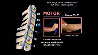 Neck Pain Cervical Disc Herniation amp Radiculopathy [upl. by Ricca859]