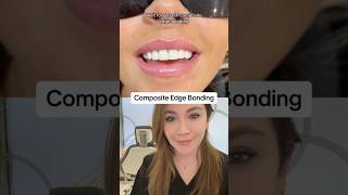 Composite Bonding To Improve The Edges Of Teeth [upl. by Paryavi]