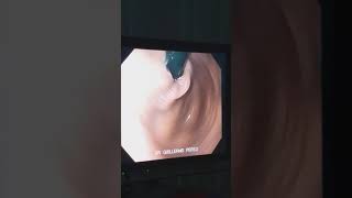 ENDOSCOPIA DIGESTIVA CON SEDACIÓN [upl. by Ulrica]