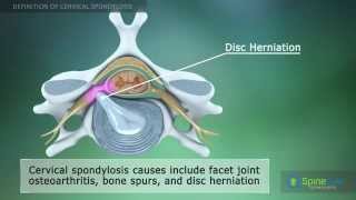 Cervical Spondylosis Definition [upl. by Kcirdek]