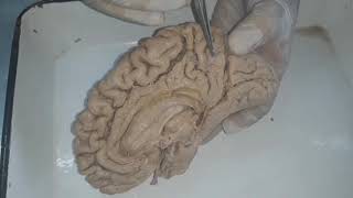 External Features of the Cerebrum 3 Neuroanatomy [upl. by Trust759]