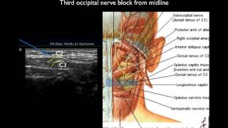 Ultrasound guided thrid occipital nerve block [upl. by Bevus]