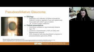 Lecture Pigmentary and Pseudoexfoliative Glaucoma [upl. by Derf731]