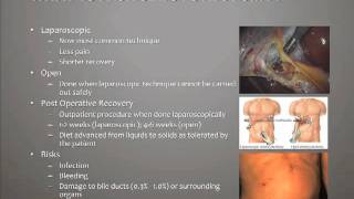 What is a Cholecystectomy [upl. by Novyad720]