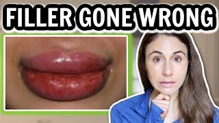 FILLER GONE WRONG 😮 TOP 5 FILLER COMPLICATIONS 💉DERMATOLOGIST DrDrayzday [upl. by Georgette]