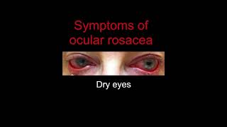 Ocular Rosacea [upl. by Enaud]