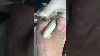 Ingrown toenail removal with Pedicure Knife Cut it easily Ep495 [upl. by Tran240]