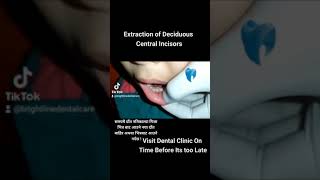 Extraction Of Deciduous Tooth [upl. by Seaddon]