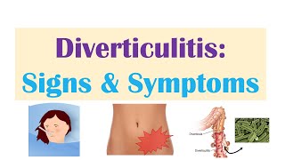 Diverticulitis Signs amp Symptoms And Why They Occur [upl. by Mcarthur]