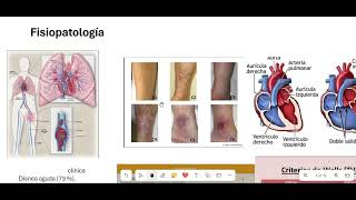 TROMBOEMBOLISMO PULMONAR PARTE 1 FISIOPATOLOGIA [upl. by Nary]