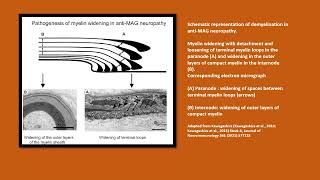 Neurology Quiz  100 Antibodies in peripheral nerve disease [upl. by Ahsenhoj993]