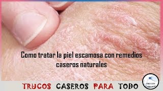 Como tratar la piel escamosa con remedios caseros naturales [upl. by Earazed]