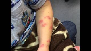 erythema multiforme caused by epilepsy med lamictal watch it progress [upl. by Narual538]