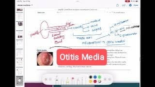 otitis media amp Mastoiditis otorhinolaryngology 3  First Aid USMLE Step 1 in UrduHindi [upl. by Previdi455]