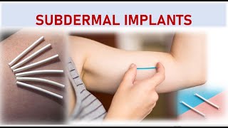 SUBDERMAL IMPLANTS Effective Hormonal Method of Female Contraceptives [upl. by Irehc]