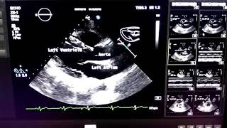 Normal Echocardiogram study [upl. by Kim]