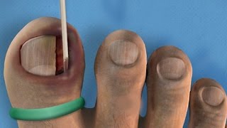 Ingrown Toenail Removal Surgery [upl. by Aiekat]