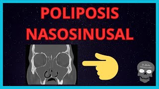 POLIPOSIS NASOSINUSAL Hallazgos👉RADIOLÓGICOS [upl. by Rednirah538]