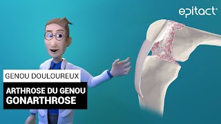 Gonarthrose  Arthrose du genou  Explications – EPITACT [upl. by Reywas]