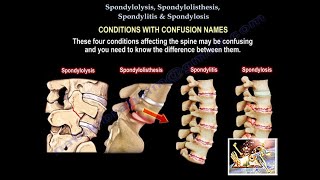 Spondylolysis Spondylolisthesis Spondylitis SpondylosisEverything Need To KnowDr Nabil Ebraheim [upl. by Grail]