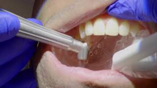 Solea Laser Dental Fillings Without Anesthesia at Fantarella Dental Group [upl. by Macri]