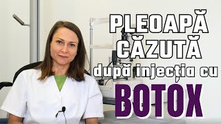 Ptoza palpebrală poate apărea după intervenții cosmetice precum injecțiile cu botox [upl. by Shyamal]