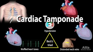 Cardiac tamponade  causes symptoms diagnosis treatment pathology [upl. by Dugald]