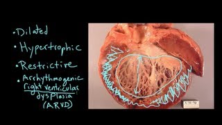 What is Cardiomyopathy [upl. by Orvas]