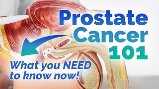 What You Need To Know About Prostate Cancer [upl. by Notnyw]