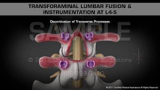 Transforaminal Lumbar Fusion amp Instrumentation at L45 [upl. by Inman]