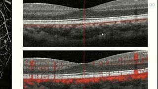 OCT Angiography Revolutionizing Vitreoretinal Disease [upl. by Ma91]