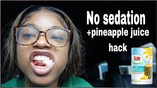 4 Wisdom teeth removed in 1 Day I Recovery Vlog Pineapple juice [upl. by Aissatsana]