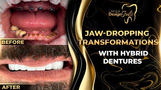 JawDropping Transformations with Hybrid Dentures [upl. by Schinica482]