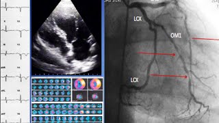 A case of ischemic cardiomyopathy ECG echo SPECT coronary angiography and treatment [upl. by Zahc]