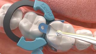 Palodent V3  Sectional Matrix System [upl. by Baer]